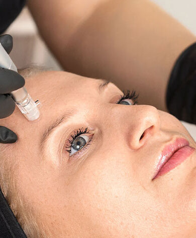 Microneedling